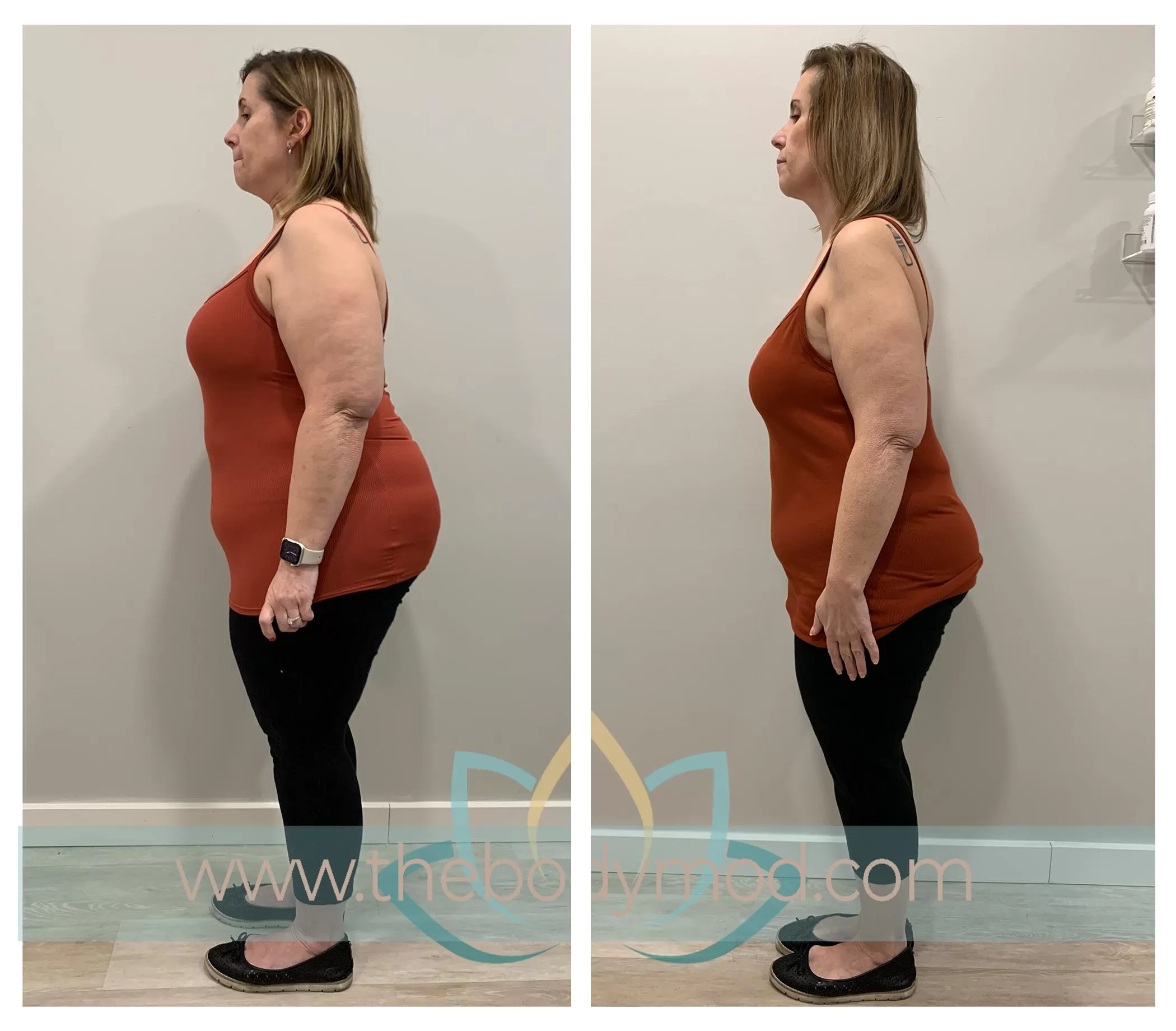 Older Woman Showing Side Profile of Before and After Weight Loss